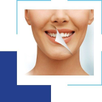 Smile Makeover: The Synergy Of Teeth Whitening And Veneers